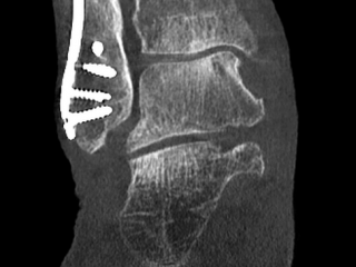 MAR Fibula Plate