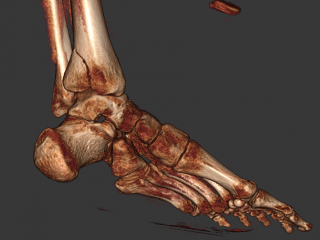 Posterior Tibia Fracture 3D